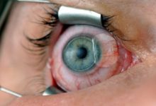 lasik göz cizdirme ameliyatı olmamak icin neden